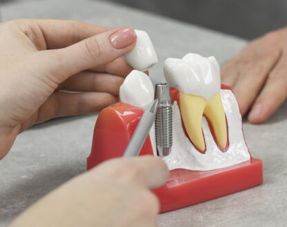 Options for Replacing Teeth with Dental Implants