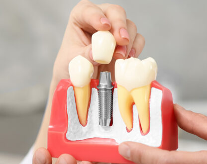 What You Need to Know About Dental Implants Burnaby