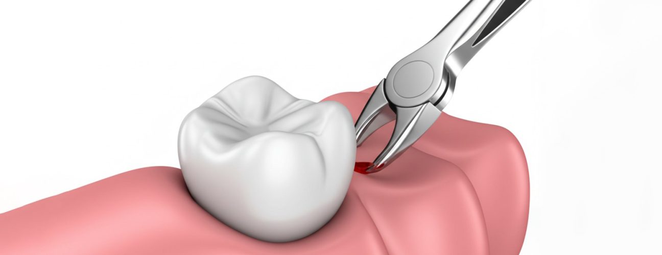 How to Care for the Surgical Site After Tooth Extraction to Promote Healing
