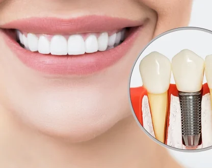 How Dental Implants Help Improve Bite Strength and Chewing Ability